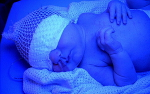 Детская желтуха у новорожденных: физиологическая желтуха