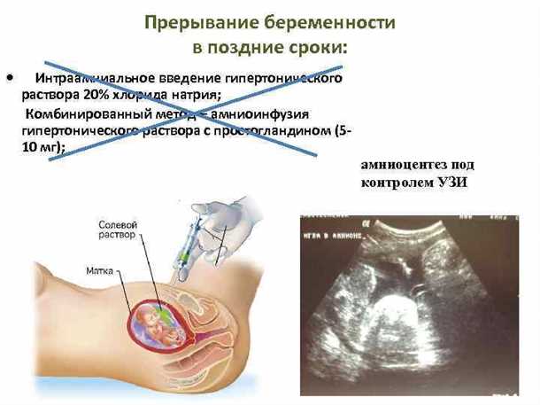Аборт на поздних сроках беременности