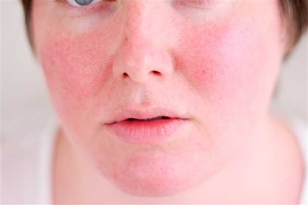 Аллергия на косметику симптомы