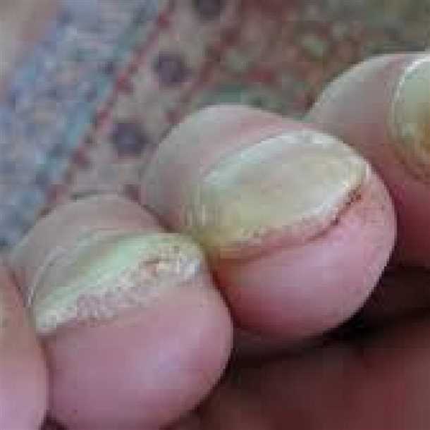 Грибок ногтевой пластины