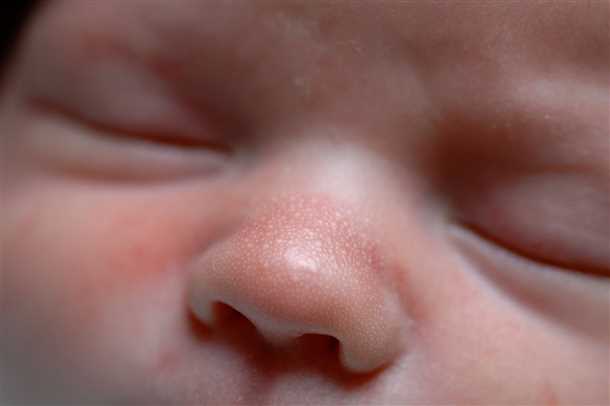Высыпание на лице у новорожденного