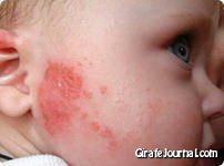 Чем лечить аллергию у детей