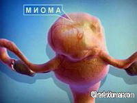 Миома и аборт