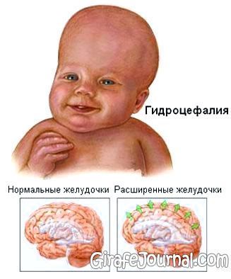 Водянка головного мозга у детей