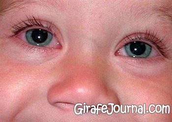 Глазные детские инфекции и лечение их тетрациклиновой мазью