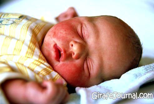 Еритема (почервоніння шкіри) у новонароджених фото