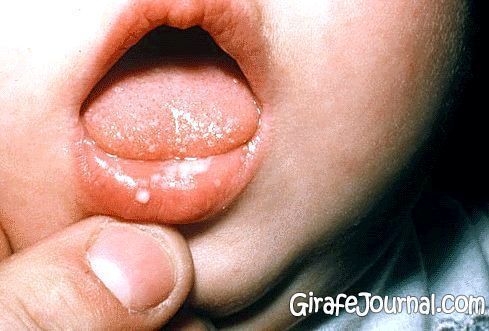 Герпесний стоматит у дітей: особливості та лікування фото