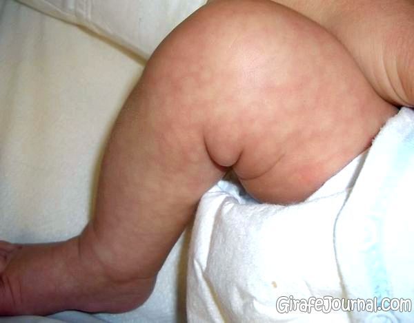 У немовляти мармурова шкіра, причини