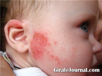 Что такое неинфекционные заболевания кожи новорожденных? фото