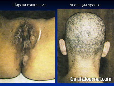 Сифилис у женщин и мужчин фото