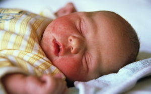 Опасна ли эритема у новорожденных?