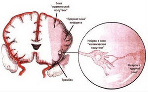 Заболевание мозга у новорожденного