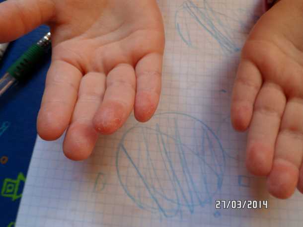 3 причины, по которым может облазить кожа на пальцах у ребенка