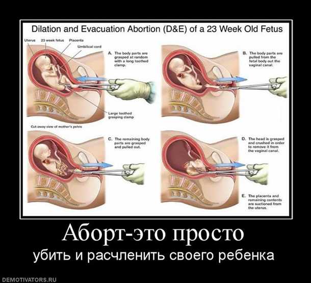 Аборт как делают