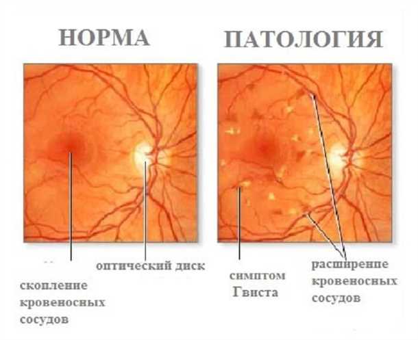 Ангиопатия сетчатки глаза у детей: ошибочный миф или суровая реальность