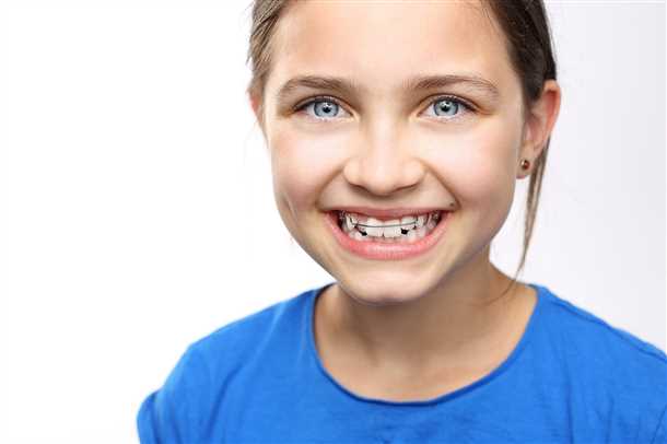 Брекеты для детей – береги зубки смолоду!