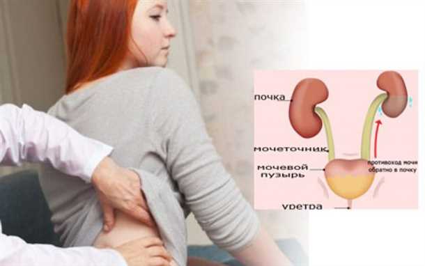 Гидронефроз при беременности: симптомы, лечение