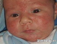 Аллергия у новорожденных фото