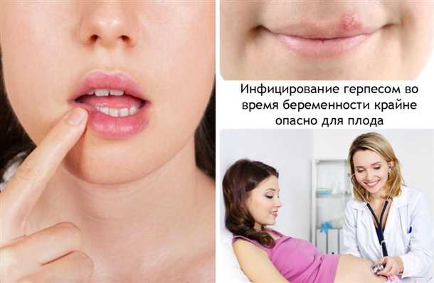 Как лечит герпес на губах во время беременности