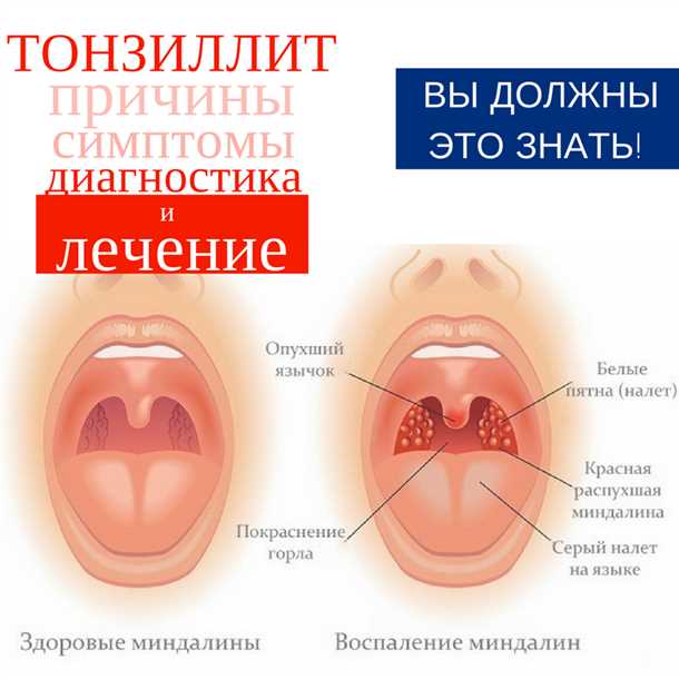Как правильно лечить горло у грудничка?