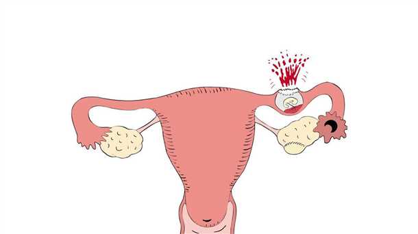 Внематочная беременность симптомы, причины