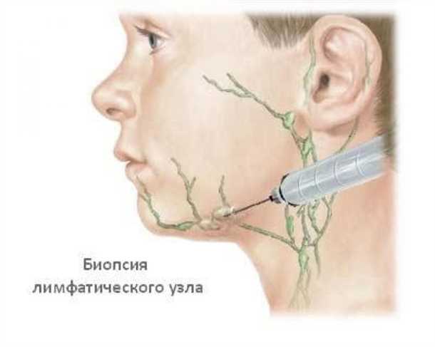 Воспаление лимфатических узлов у детей, лечение и профилактика