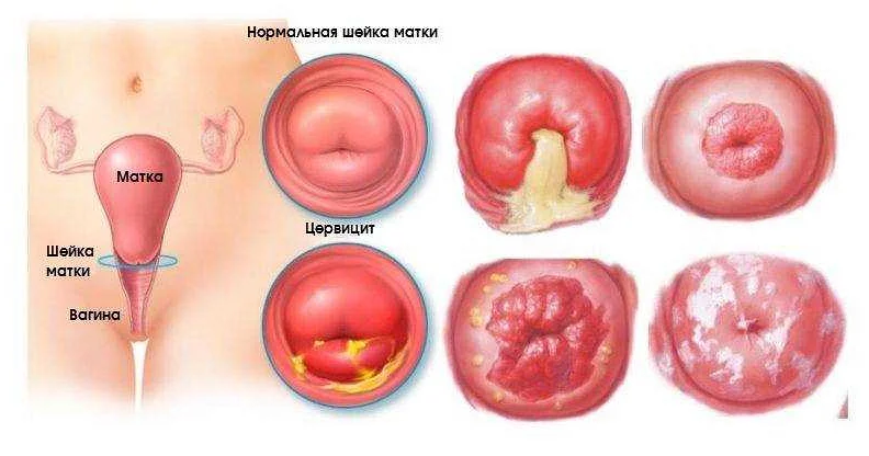 Воспаление шейки матки - симптомы и лечение