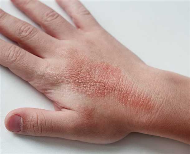 Заболевания кожи у детей