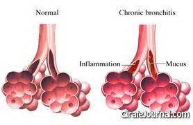 Симптомы хронического бронхита