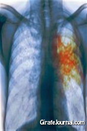 Симптомы туберкулёза лёгких
