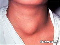 Симптомы рака щитовидной железы