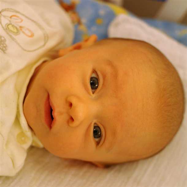 Желтушка – желтуха новорожденных